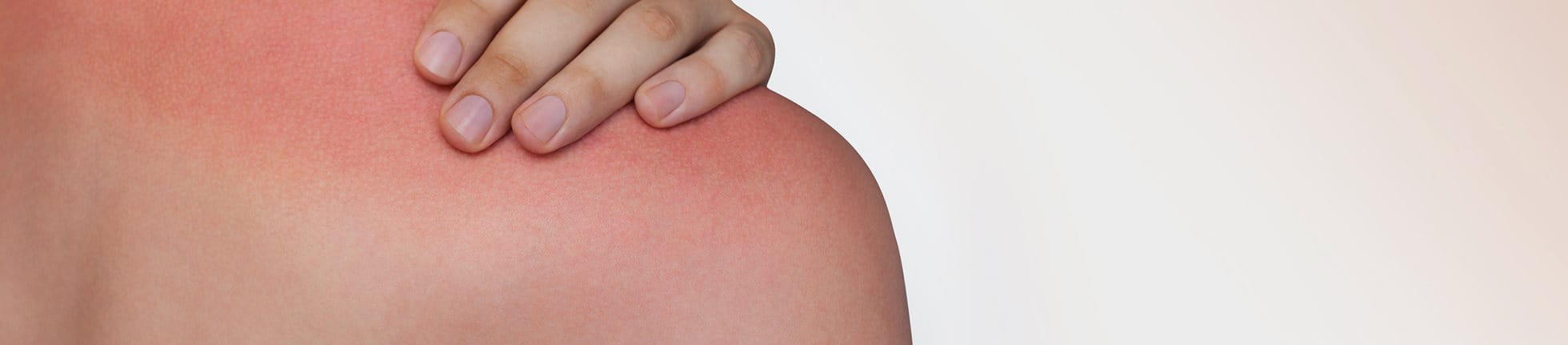 Frau hält sich die schmerzende Schulter mit Sonnenbrand