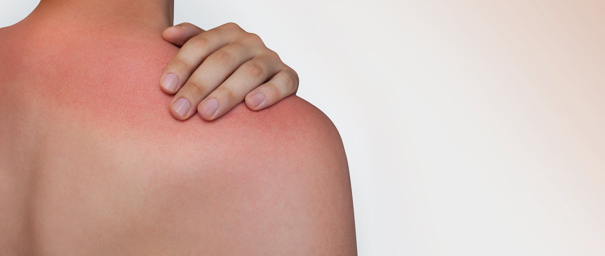 Sonnenbrand Was Jetzt Wirklich Hilft Eucerin