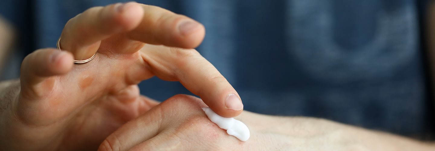 Hände eines Mannes, der Creme auf seinem Handrücken verteilt