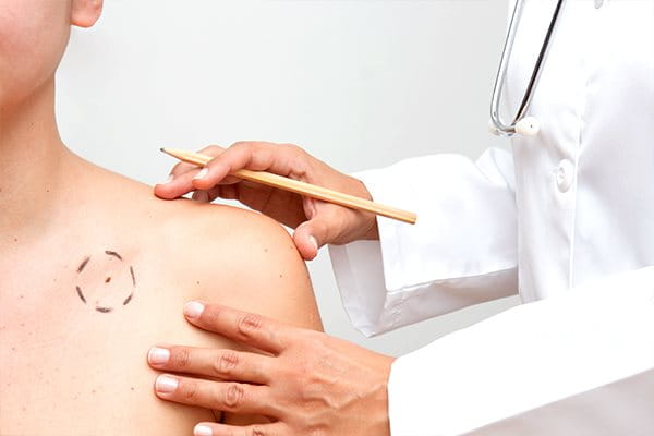 Muttermale sollten regelmäßig vom Hautarzt kontrolliert werden