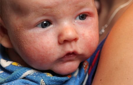 Säugling mit Neurodermitis im Gesicht