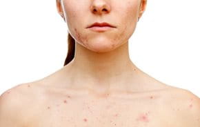 Unreine Haut Ursachen Tipps Zur Behandlung Eucerin