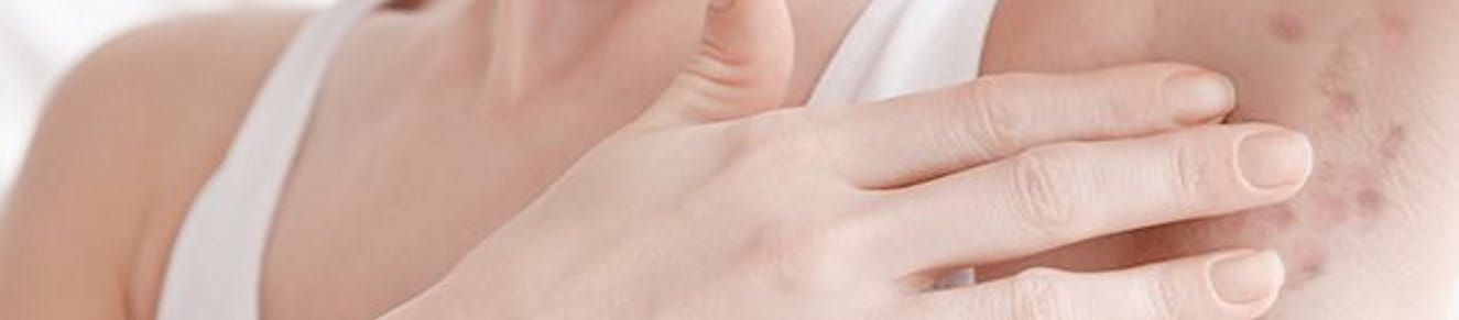 Acne inversa in der Achselhöhle