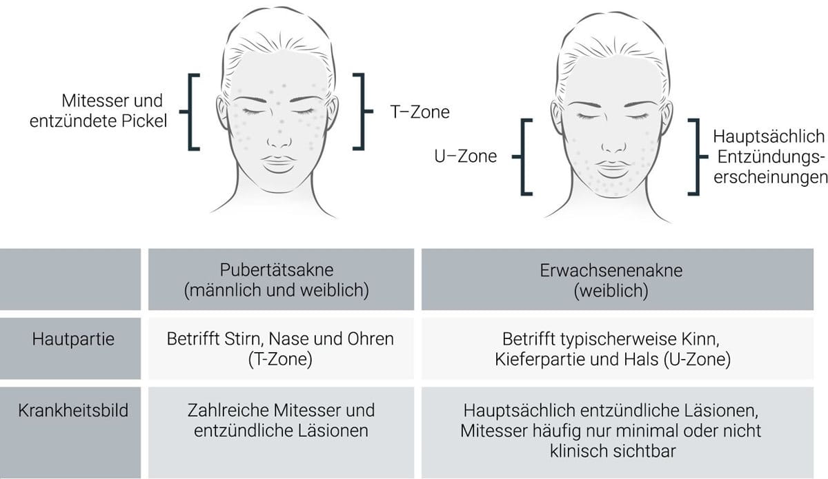 Pickel am Hals – Ursachen erkennen und behandeln | Eucerin