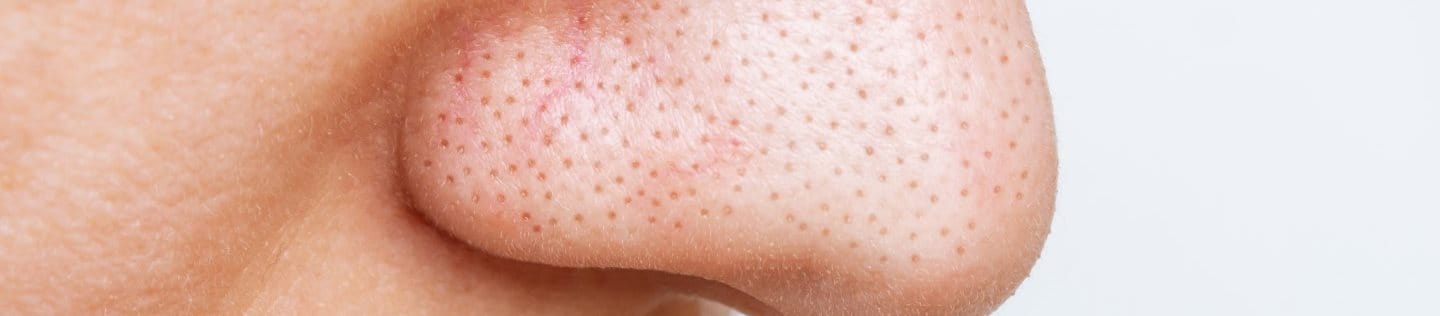 Bild einer Nase mit Blackheads.