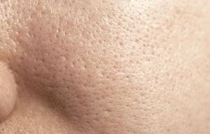 Fettige Haut mit großen Poren