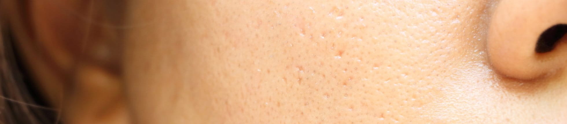 Fettige Haut mit großen Poren im Gesicht