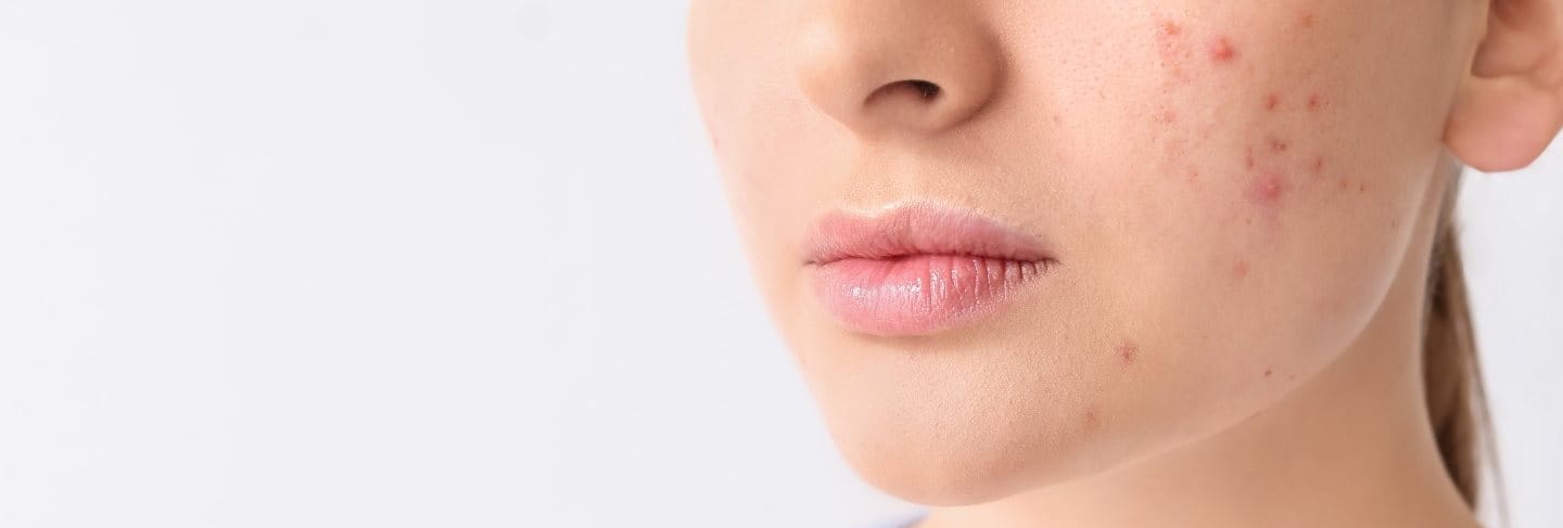 Juckende Pickel: Die Ursache erkennen und behandeln