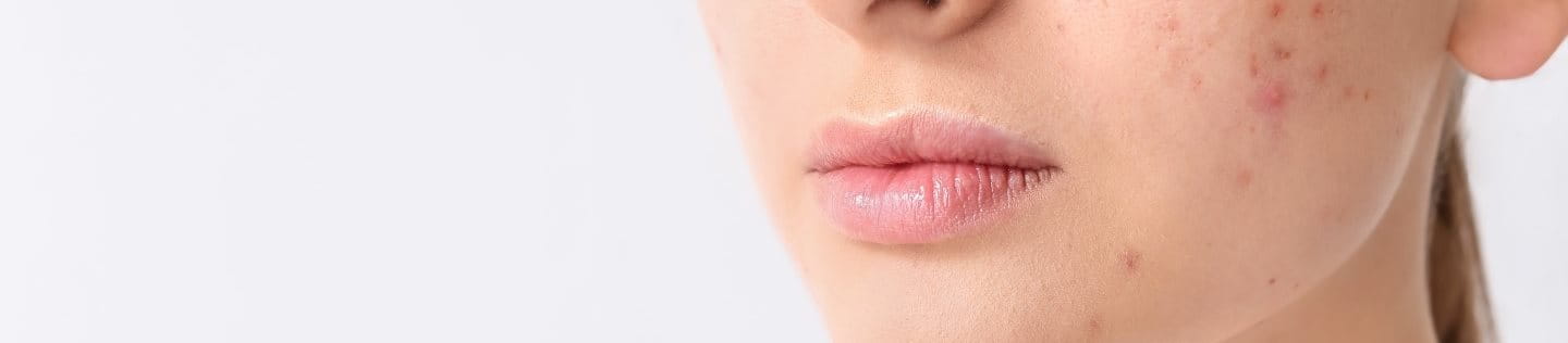 Juckende Pickel: Die Ursache erkennen und behandeln