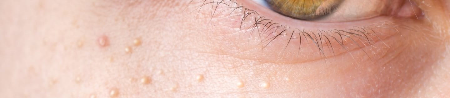 Milien unter dem Auge