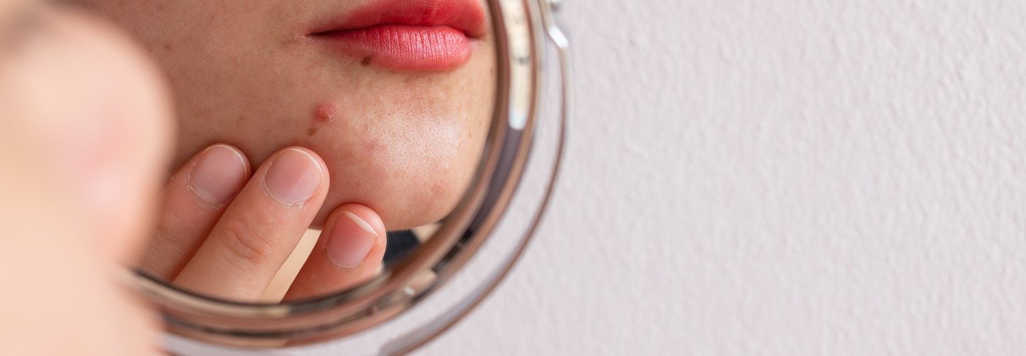 Angeschnittenes Spiegelbild einer weiblichen Person in einem runden Kosmetikspiegel, die einen Pickel am Kinn begutachtet und die Haut darunter mit den Fingern ihrer linken Hand befühlt. 