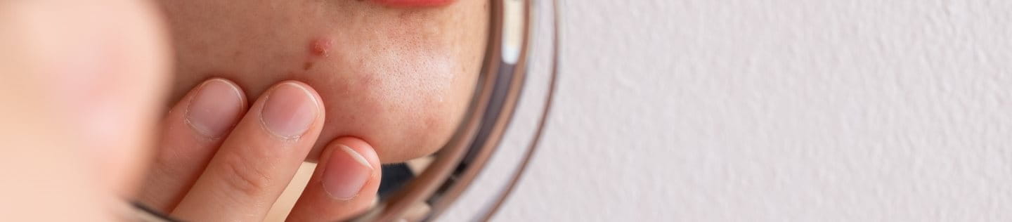 Angeschnittenes Spiegelbild einer weiblichen Person in einem runden Kosmetikspiegel, die einen Pickel am Kinn begutachtet und die Haut darunter mit den Fingern ihrer linken Hand befühlt.