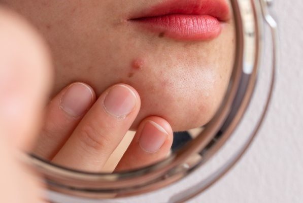 Angeschnittenes Spiegelbild einer weiblichen Person in einem runden Kosmetikspiegel, die einen Pickel am Kinn begutachtet und die Haut darunter mit den Fingern ihrer linken Hand befühlt.