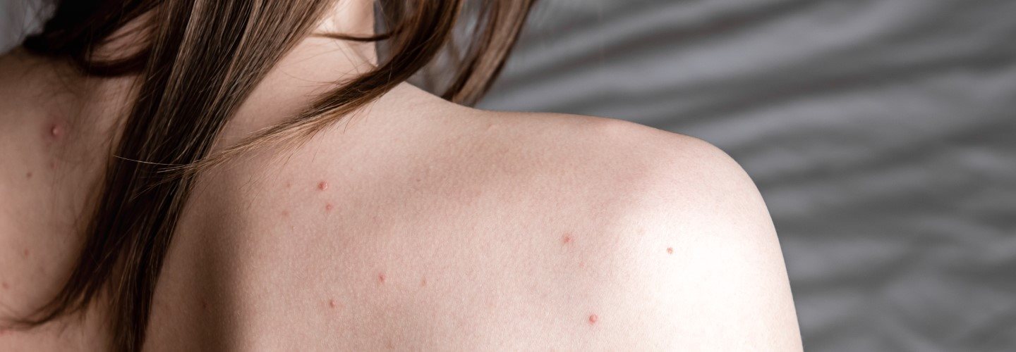 Ansicht einer Frau von hinten mit Pickeln auf Rücken und Schultern. 