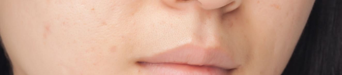 Nahaufnahme des Gesichts einer Person, auf der mehrere kleine Pickel auf der Wange und um den Mund herum zu sehen sind.