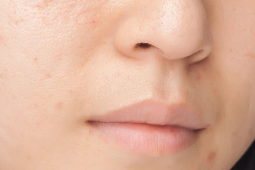 Close-up of a person's face showing several small pimples on the cheek and around the mouth.