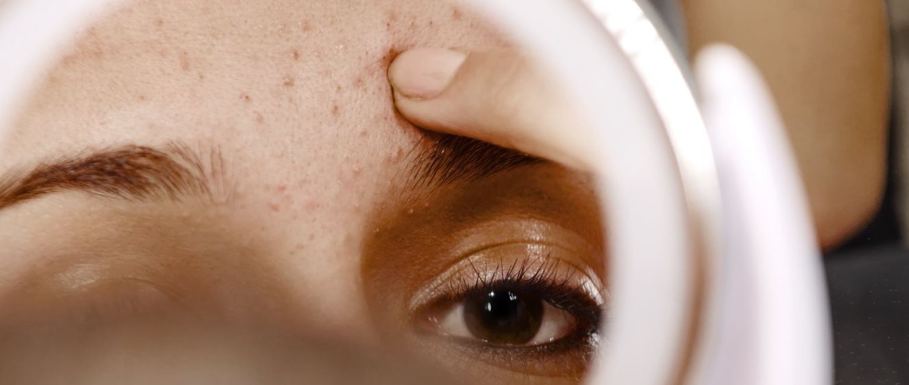 Akne auf der Stirn