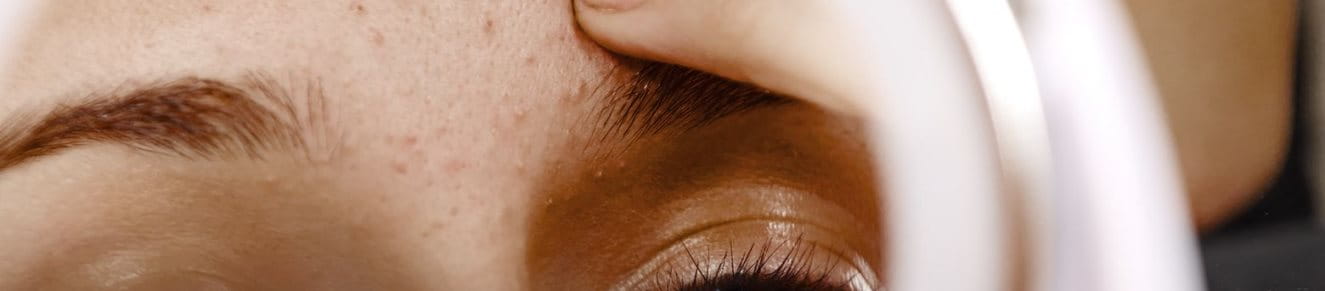 Akne auf der Stirn