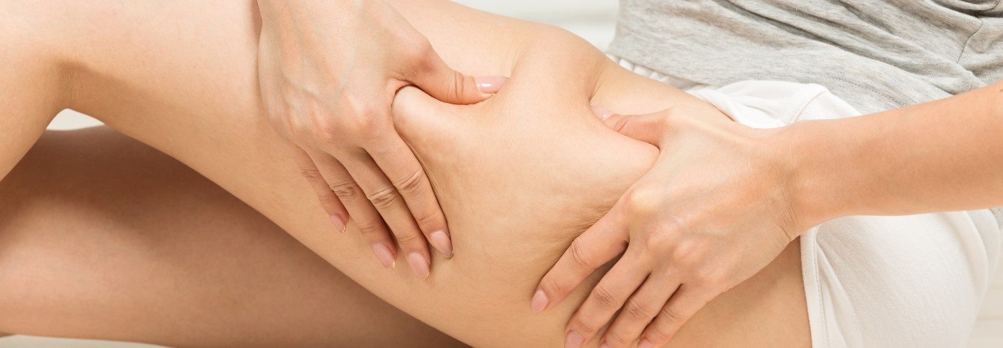 Cellulite am Oberschenkel einer Frau.