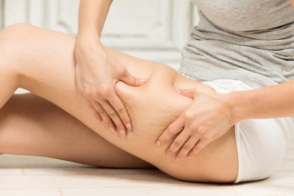 Cellulite am Oberschenkel einer Frau.