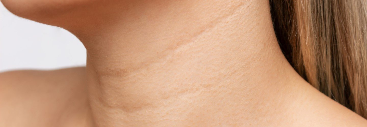 Waagerechte Falten am Hals einer Frau.