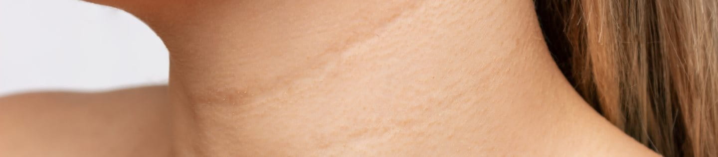 Waagerechte Falten am Hals einer Frau.