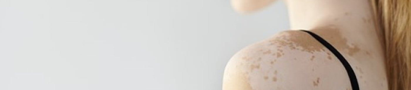 Junge Frau mit Vitiligo (Weißfleckenkrankheit)