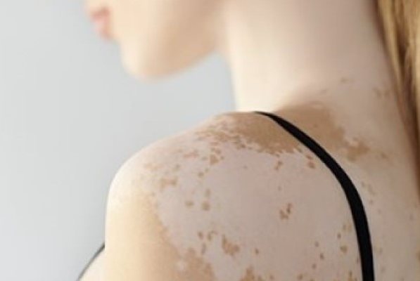 Junge Frau mit Vitiligo (Weißfleckenkrankheit)
