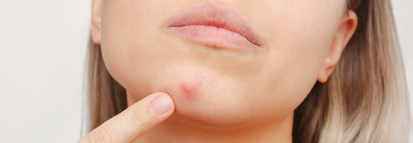 Unterirdische Pickel am Kinn