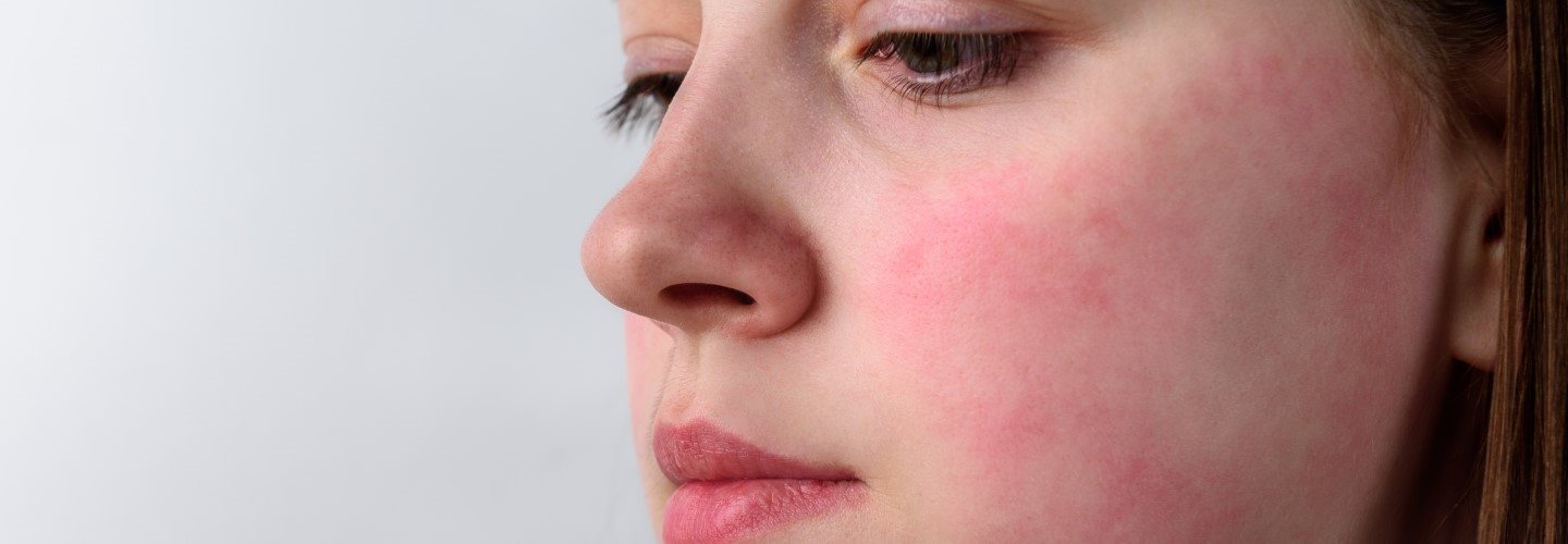 Frau mit Gesichtsrötungen