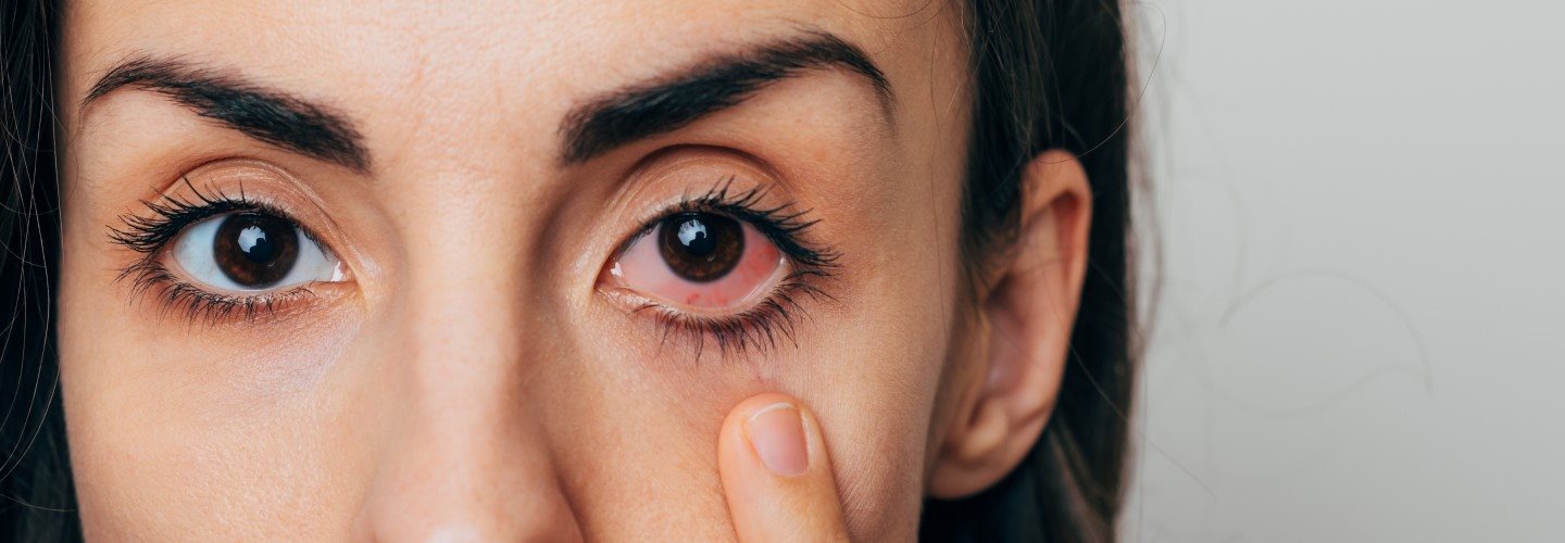 Frau mit gerötetem Auge