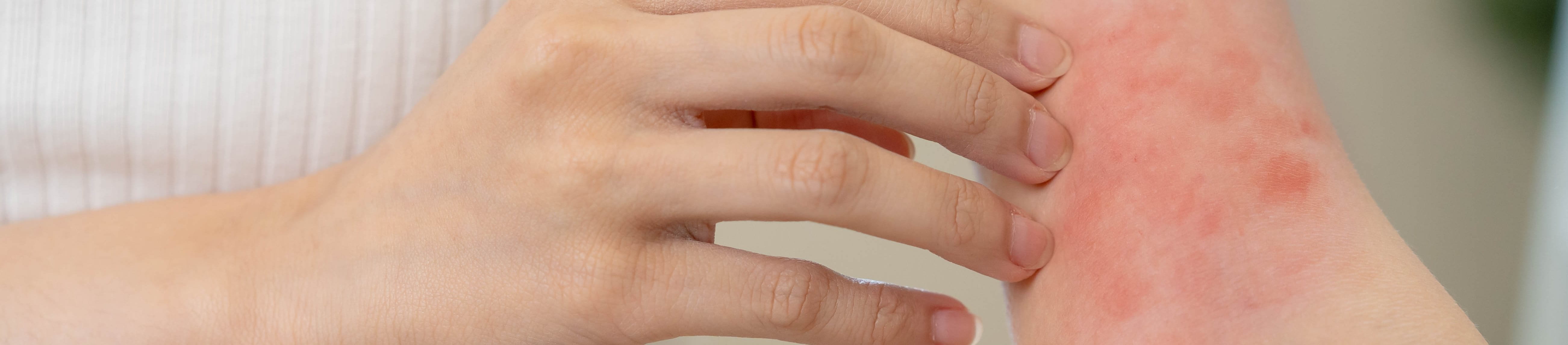 Dermatitis in der Ellenbeuge