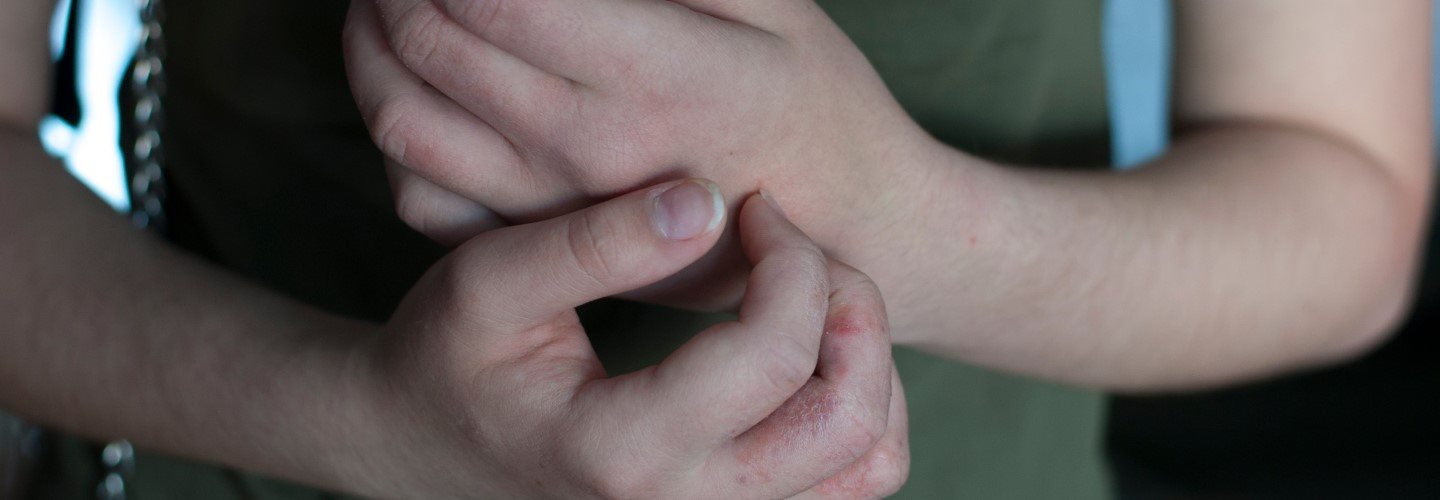 Frau mit Scabies-Ausschlag an den Händen
