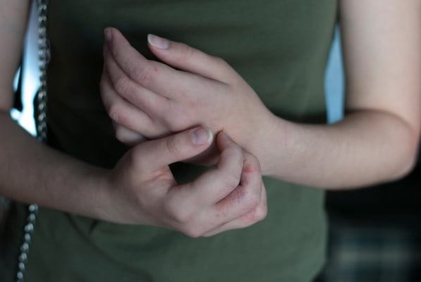 Frau mit Scabies-Ausschlag an den Händen