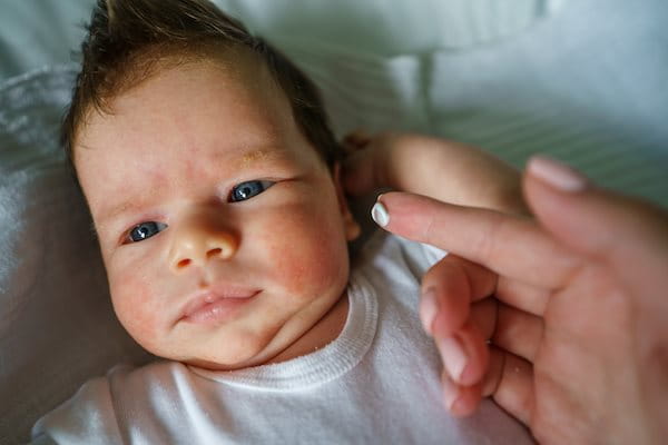 Gesicht eines Babys, das Neurodermitis auf den Wangen hat