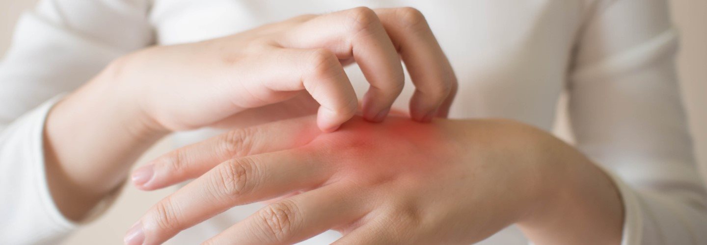 Eine Person kratzt sich an den geröteten Händen. Ein dyshidrotisches Ekzem verursacht Juckreiz.