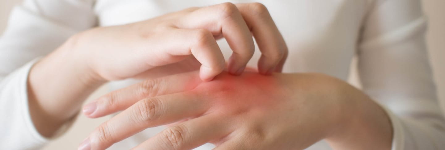 Dyshidrotisches Ekzem behandeln und pflegen | Eucerin