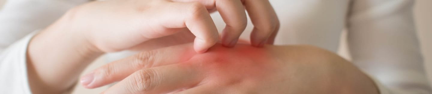 Eine Person kratzt sich an den geröteten Händen. Ein dyshidrotisches Ekzem verursacht Juckreiz.