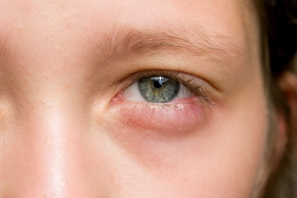Schuppige Haut und Neurodermitis am Auge