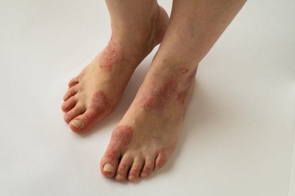 Beine von Person mit Neurodermitis am Fuß