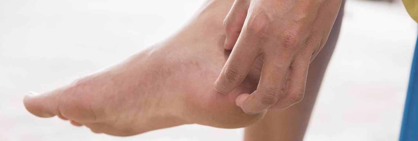 Neurodermitis am Fuß – Ursachen & Tipps | Eucerin