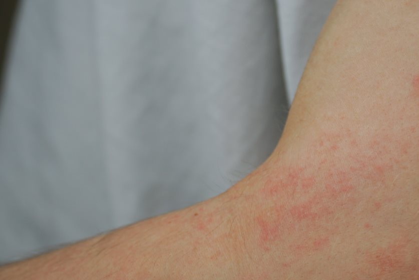 Rote Flecken auf der Haut am Arm