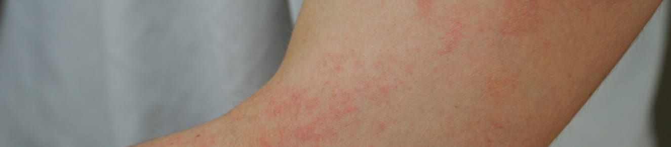 Gros plan sur le creux d'un bras avec des taches rouges et des zones de peau sèche.