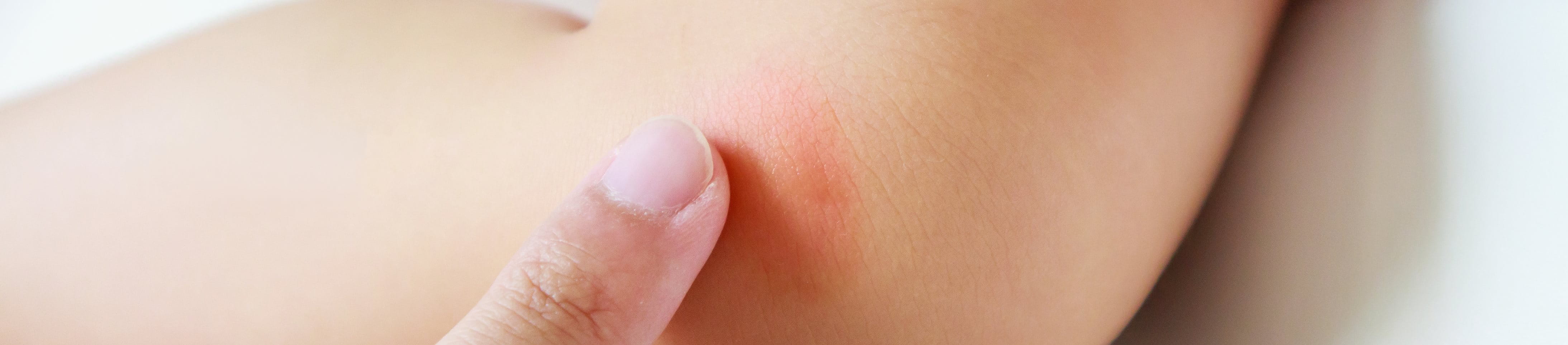 Gerötete Haut am Knie eines Babys wird mit einem Finger berührt