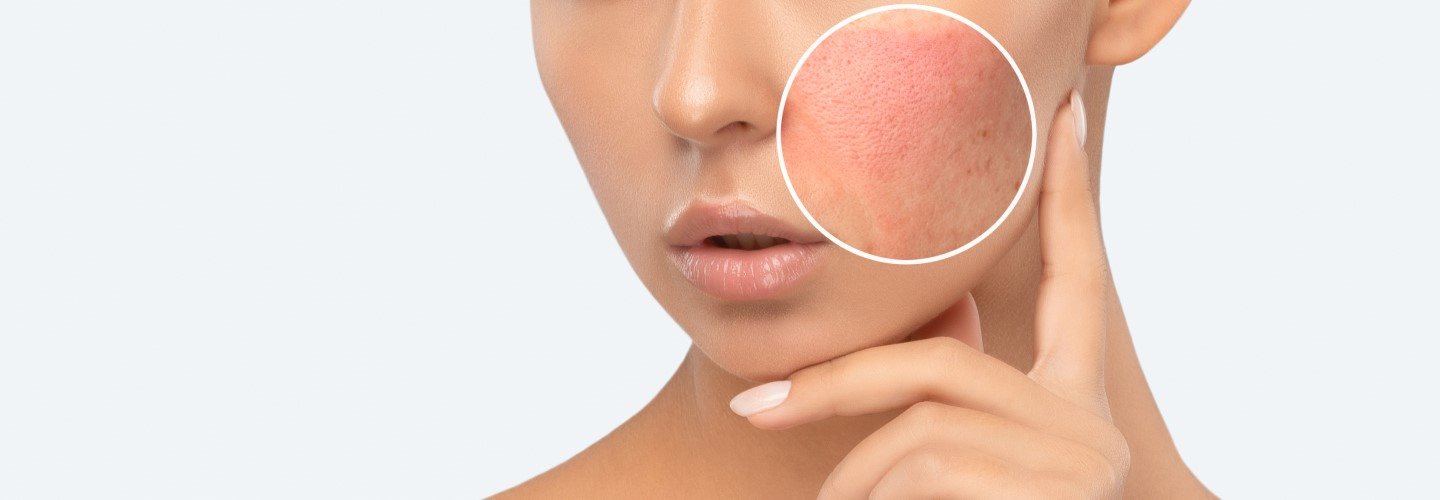 Hautirritation im Gesicht