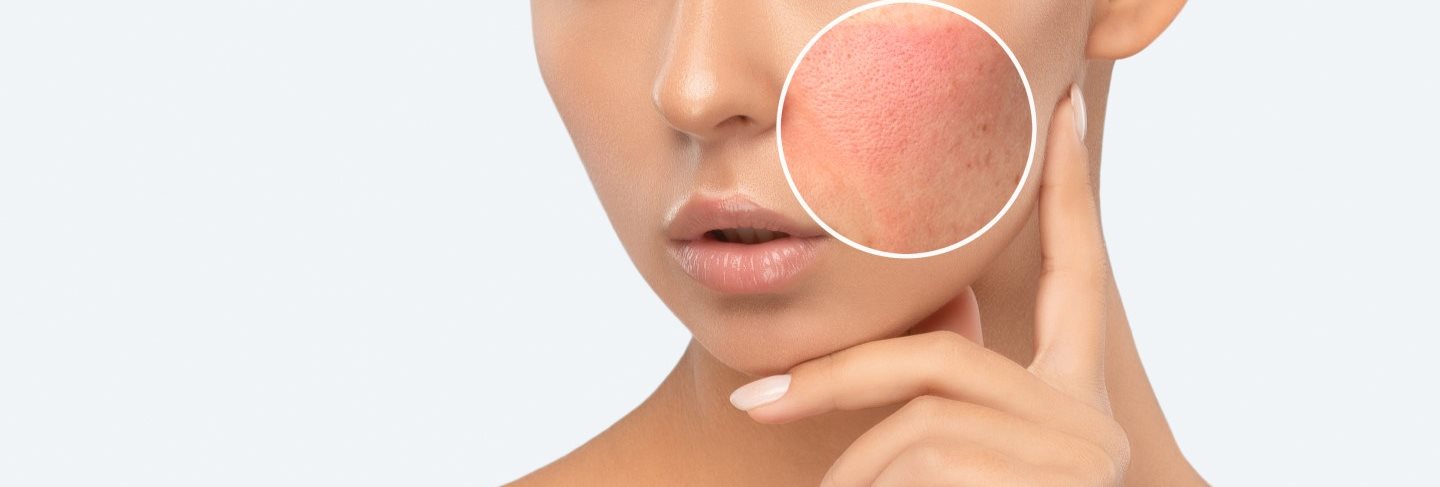 Hautirritationen im Gesicht und am Körper behandeln 5 Tipps
