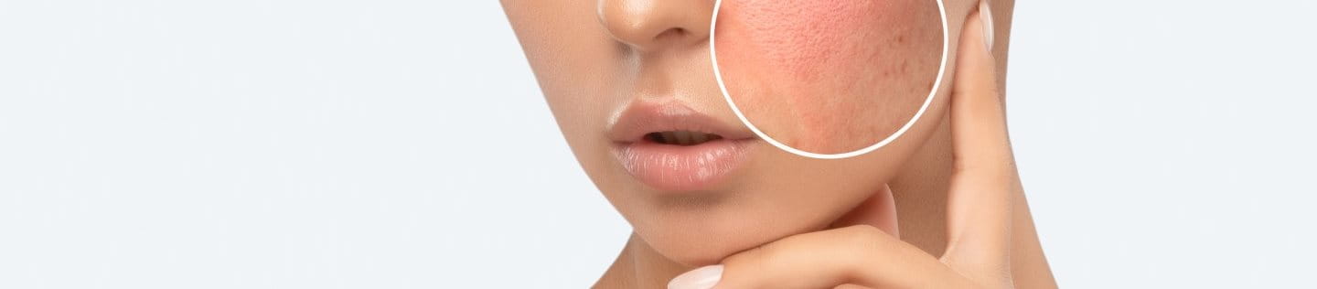 Hautirritation im Gesicht