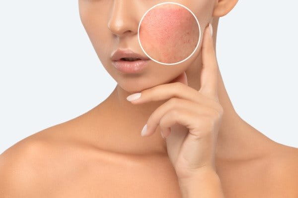 Hautirritation im Gesicht