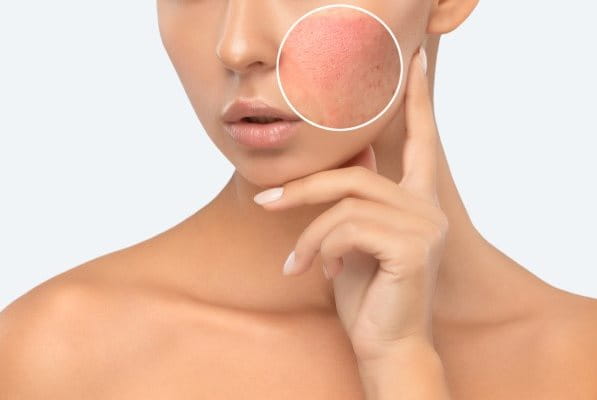 Hautirritation im Gesicht