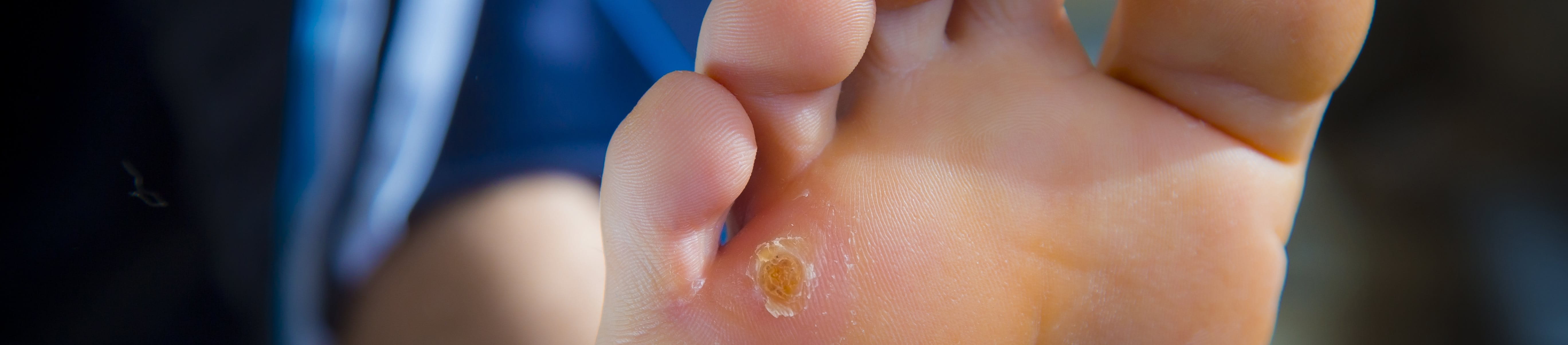 Nahaufnahme vom Fuß einer Frau mit schmerzhaftem Hühnerauge an der Fußsohle